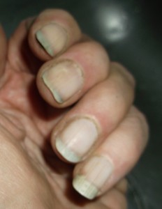 Dirty Fingernails